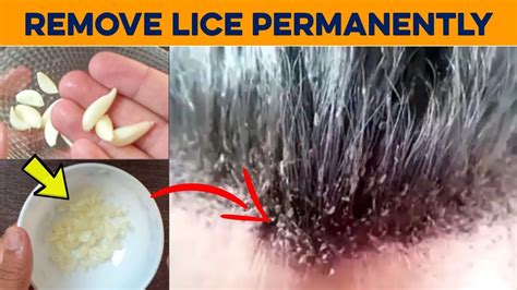 how to get rid of lice fatintroduction28