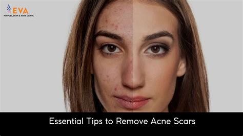 Essential Tips To Remove Acne Scars