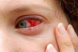 Images of Eye Gene Eye Drops Side Effects