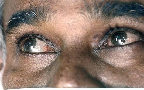 Why Does A Jaundiced Persons Eyes And Skin Look Yellow The Hindu
