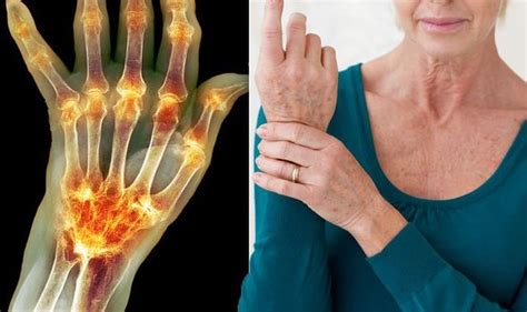 Arthritis Pain Symptoms And Signs Of The Joint Pain Condition Include