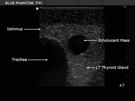 Thyroid Biopsy Ultrasound Training Model
