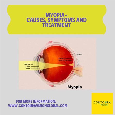 Myopia Causes Symptoms And Treatment Contoura Vision Global Flickr