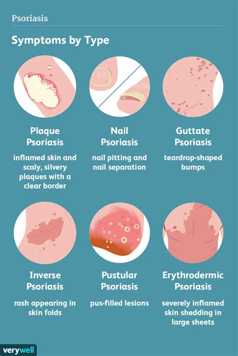 Psoriasis Symptoms And Complications