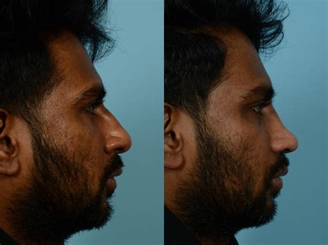 Rhinoplasty By Dr Sinno Before And After Pictures Case 693 Chicago
