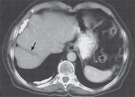 19 Liver Radiology Key