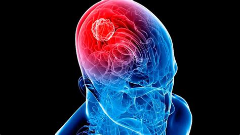 Los Tumores Cerebrales Tipos Y Síntomas Principales