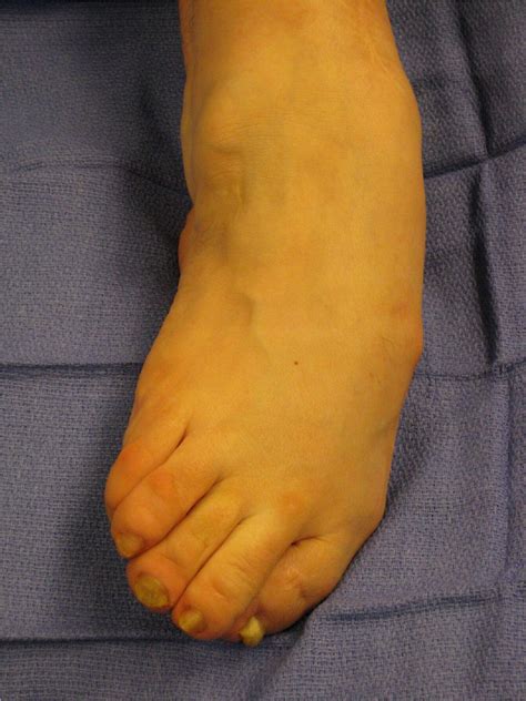 Management Of Paralytic Equinovalgus Deformity Foot And Ankle Clinics