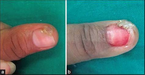 Nail Avulsion With Adjuvant Therapy In Nail Disorders Suthar Hp Patel
