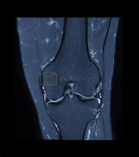 Compare Of Mri Knee Or Magnetic Resonance Imaging Of Knee Joint Stir