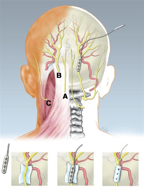 Figure From Occipital Nerve Stimulation For Intractable Occipital