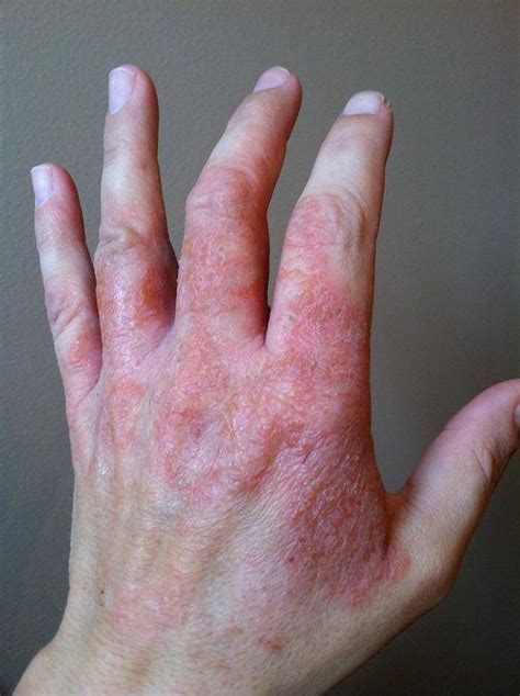 Severe Rash On Hands Rash On Hands Eczema Cure Contact Dermatitis
