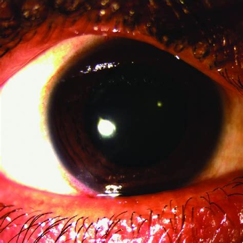 Grossly Reduced Conjunctival Congestion And Resolving Corneal Ulcer Of