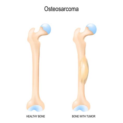 Everything You Need To Know About Bone Cancer Overview