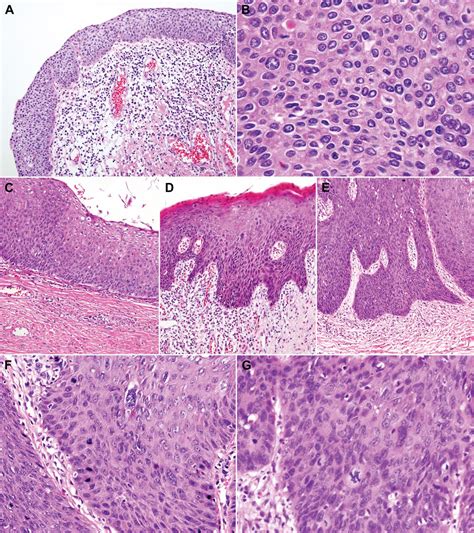 Clinicopathological Characteristics Of High Grade Squamous Intraepithelial Lesions Involving