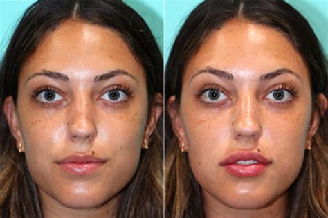 lip augmentation before and after photos page 6 of 6 the naderi center for plastic surgery