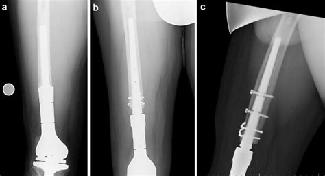 A Distal Femur Replacement With Pre Existing Cemented Modular Femoral