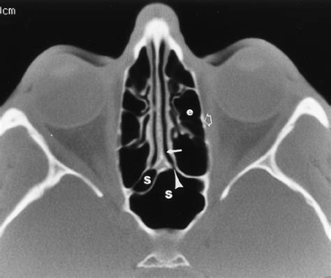 The Paranasal Sinuses Radiology Key