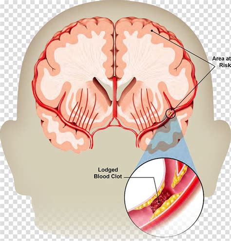 Human Brain Stroke Illustration Stroke Disease Ischemic My Xxx Hot Girl