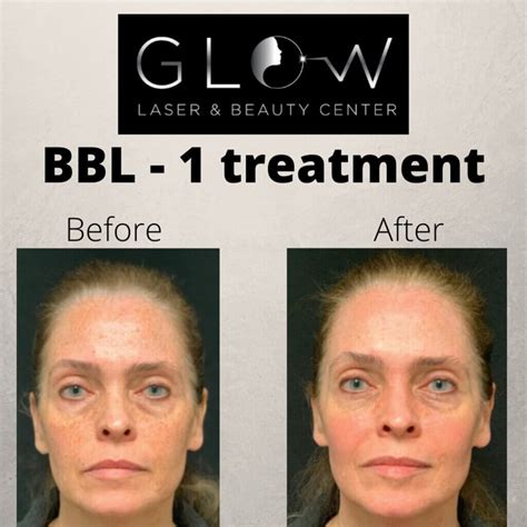 Forever Young Bbl Treatment In Erie Pa Glow Laser Beauty