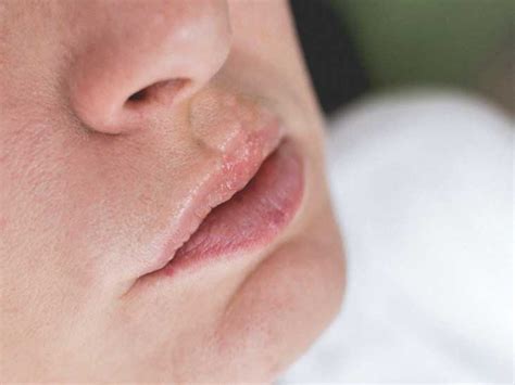 Swelling Lips And Hives