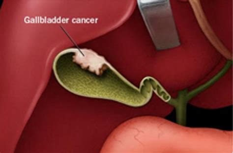 Gallbladder Cancer