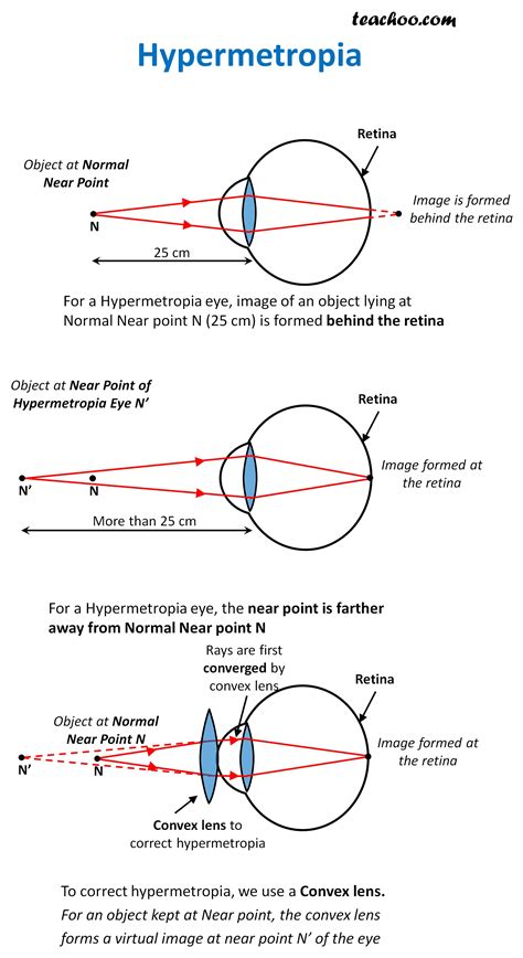 Myopia Ray Diagram