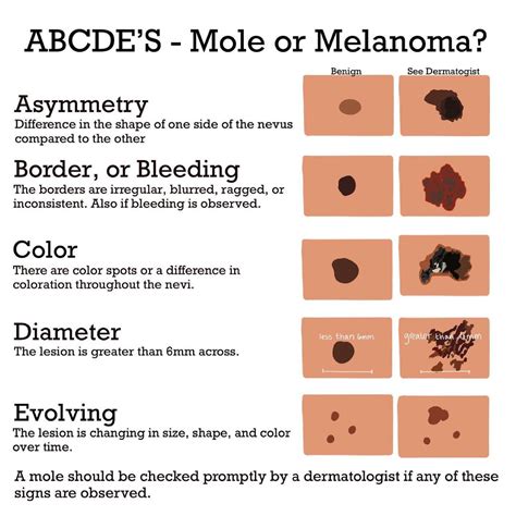 Benign Nevus Vs Melanoma