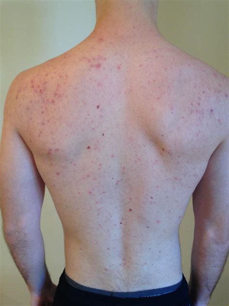 Pityrosporum Folliculitis Faq Backbodyneck Acne By White Fox