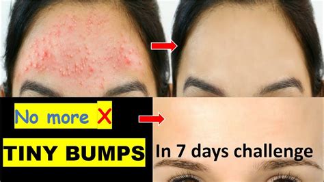 7 Days Challenge😍 Treat Tiny Bumps Naturally At Home Get Rid Of Tiny