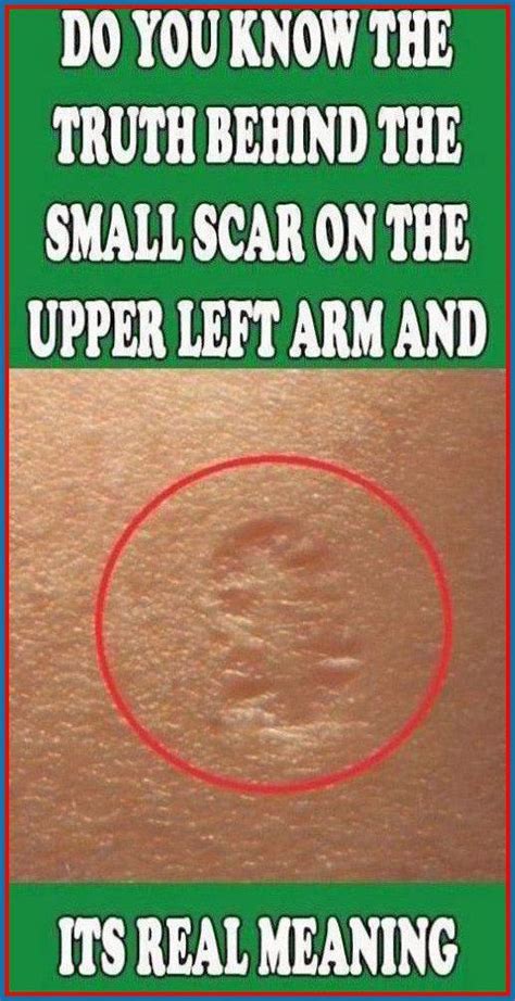 this is the truth behind the scar everyone has on the upper left arm in 2020 medicine book