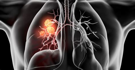lungenkrebs bronchialkarzinom