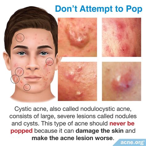 Should You Pop Cystic Acne