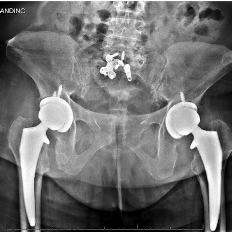 Ap Pelvis Radiograph Obtained 7 Months After Left Tha And 2 Months