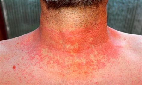 Scarlet Fever Returns As Doctors Are Warned About Possible Outbreak