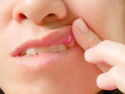 Cold sores (fever blisters) occur on the outer lip, whereas canker sores are found inside the mouth. Stomatitis: Types, causes, and treatment