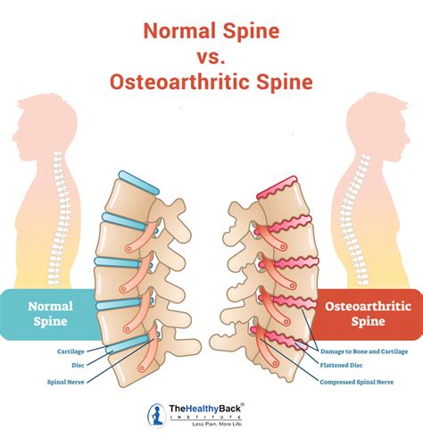 Spinal Arthritis Causes Symptoms And Treatments