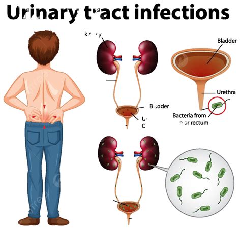 Informative Illustration Of Urinary Tract Infections Pain Unwell Infections Vector Pain Unwell