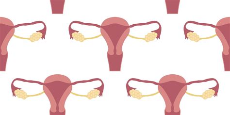 Ovarian Cysts Symptoms Causes And Treatment