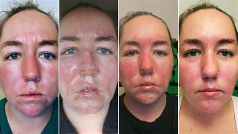 The following is an overview of first and second degree burns, including pathophysiology and treatment. Woman Shares 2nd Degree Facial Burn Healing Process ...