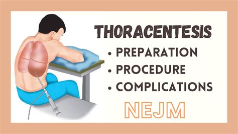 Thoracentesis Preparationl And Procedure Steps Tutorial Nejm Ms