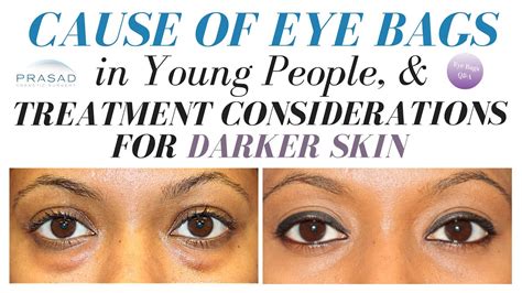 What Causes Eye Bags Under Eye Bags How To Minimise The Appearance