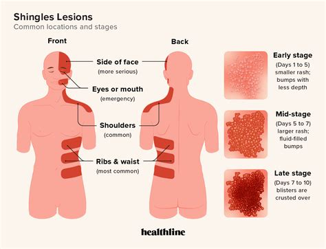 How To Identify A Shingles Rash On The Back Dermatomes Chart And Map