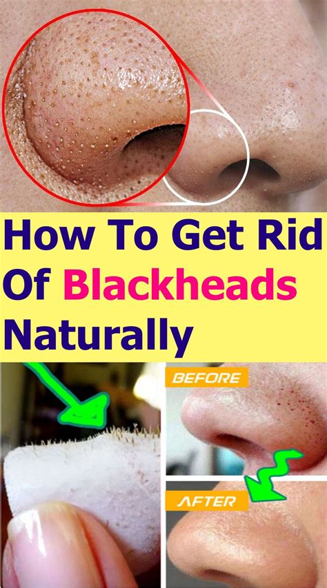 View How To Get Rid Of Blackheads Naturally Wikihow  What Is