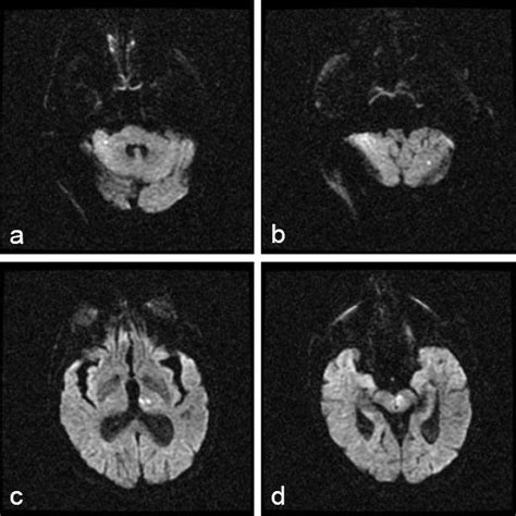 Diffusion Weighted Magnetic Resonance Image Showing Punctate Diffusion