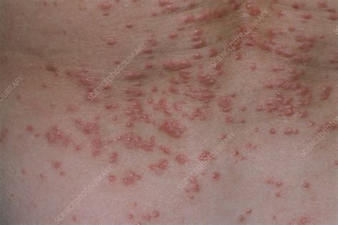 Red Papules Lumps On The Skin Due To Scabies Stock Image M260