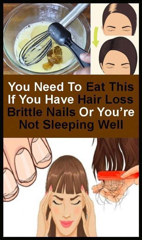 Pin On Hair Loss Prevention