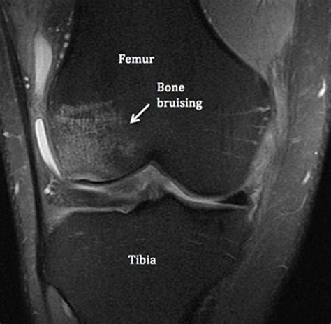 Bone Bruise Causes Symptoms Diagnosis Treatment And Healing Time