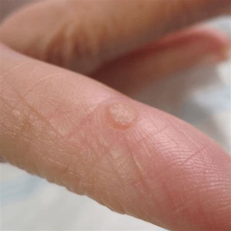 How To Easily Get Rid Of Warts On Hands Overnight 2021 Update