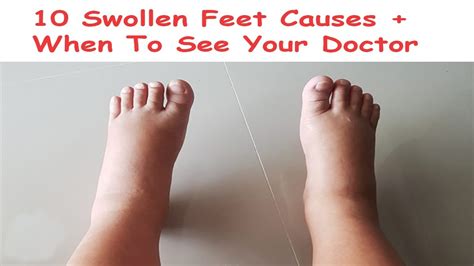 10 Swollen Feet Causes When To See Your Doctor Swollen Feet And